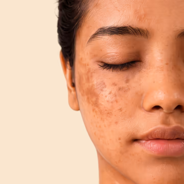 Pigmentation