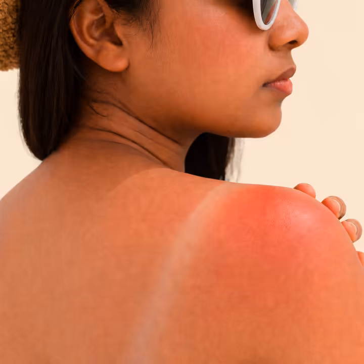 Sunburn